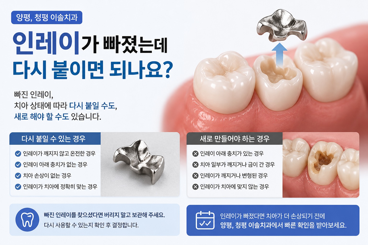 탈락 인레이에 대한 설명